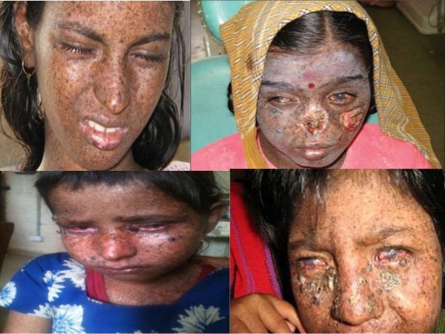 xeroderma pigmentosum brain xeroderma pigmentosum di indonesia